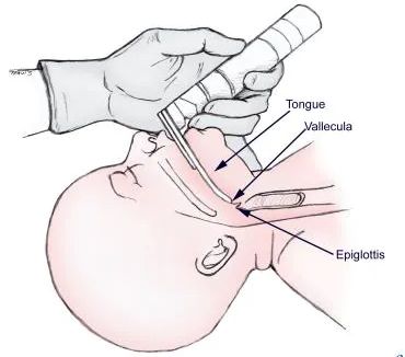 Intubation