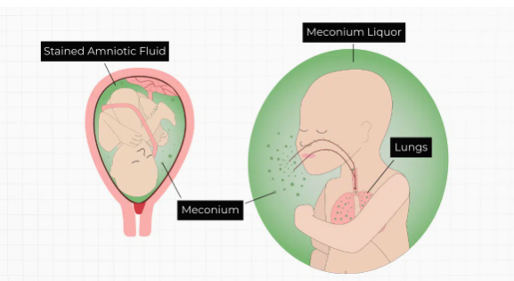 Meconium aspiration syndrome (MAS)