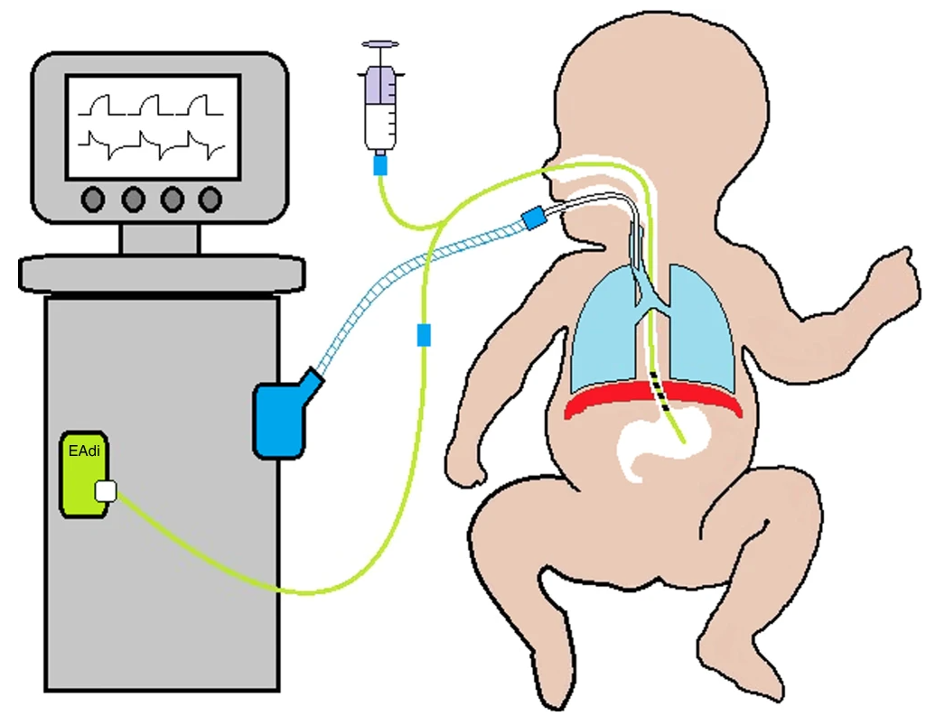 Neurally adjusted ventilatory assist (NAVA)